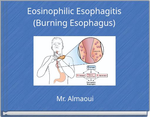 Eosinophilic Esophagitis (Burning Esophagus)