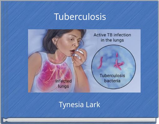 Tuberculosis