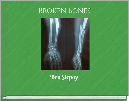 Broken Bones