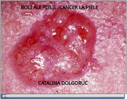BOLI   ALE  PIELII . CANCER  LA PIELE