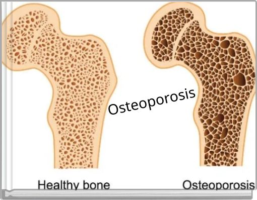 Osteoporosis